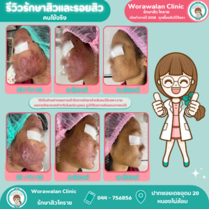 โปรแกรมรักษาสิวและฟื้นฟูรอยแผลเป็นจากสิว วรวลัญช์ คลินิก โดยหมอเจี๊ยบ โคราช