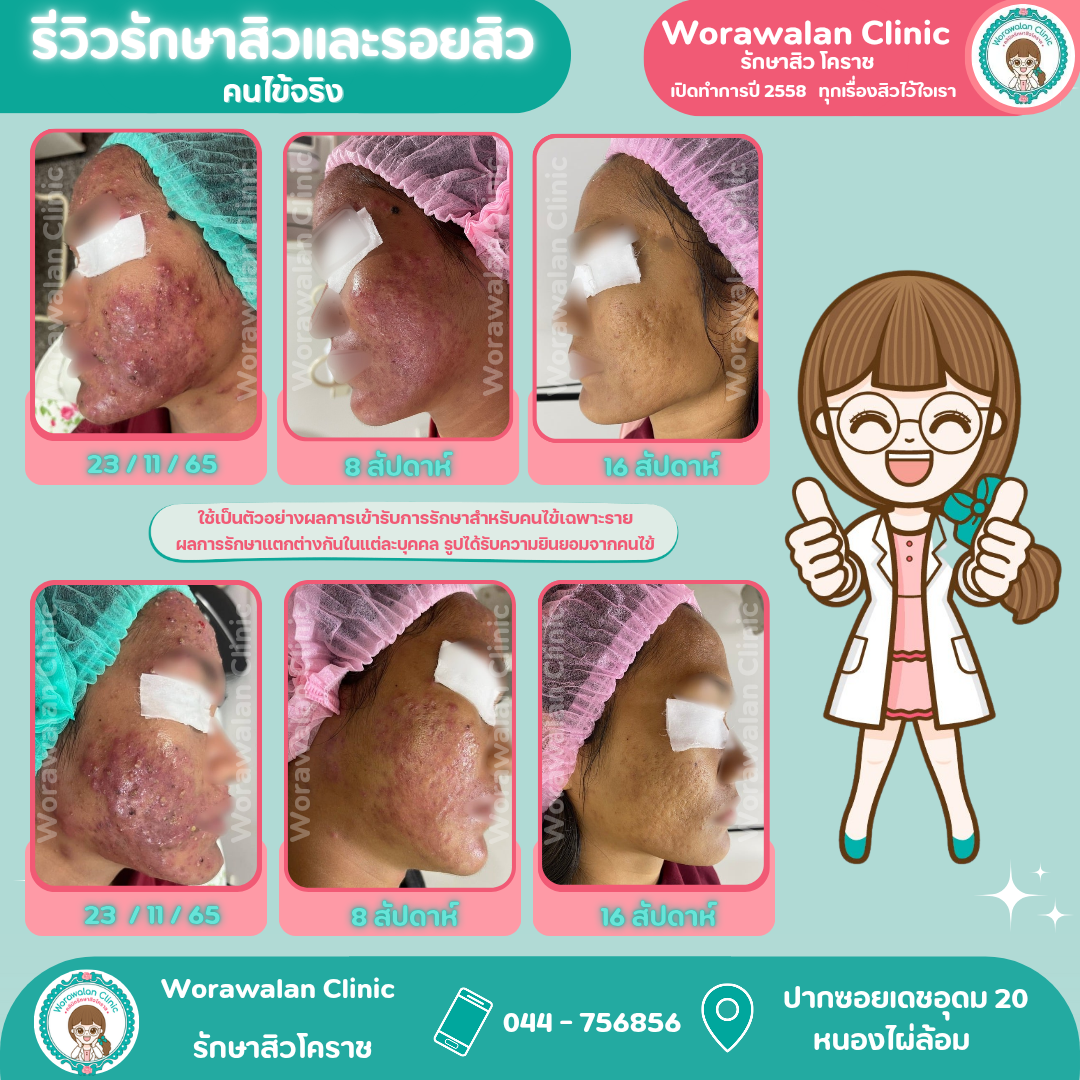 โปรแกรมรักษาสิวและฟื้นฟูรอยแผลเป็นจากสิว วรวลัญช์ คลินิก โดยหมอเจี๊ยบ โคราช