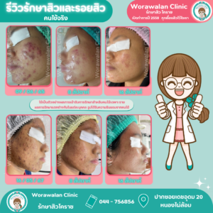 รักษาปัญหาสิวและผิวพรรณด้วยเทคโนโลยีมาตรฐาน รีวิวคนไข้จริง วรวลัญช์ คลินิก โคราช