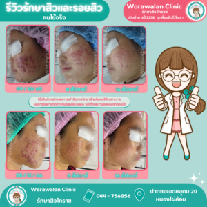 รีวิวเคสรักษาสิวอุดตันฝังลึก เห็นการเปลี่ยนแปลงชัดเจน วรวลัญช์ คลินิก รักษาสิวโคราช