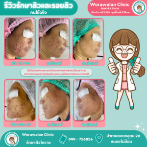 ภาพเปรียบเทียบก่อนหลังรักษาสิวและรอยดำสิว หมอเจี๊ยบ วรวลัญช์ คลินิก ประสบการณ์ 11 ปี