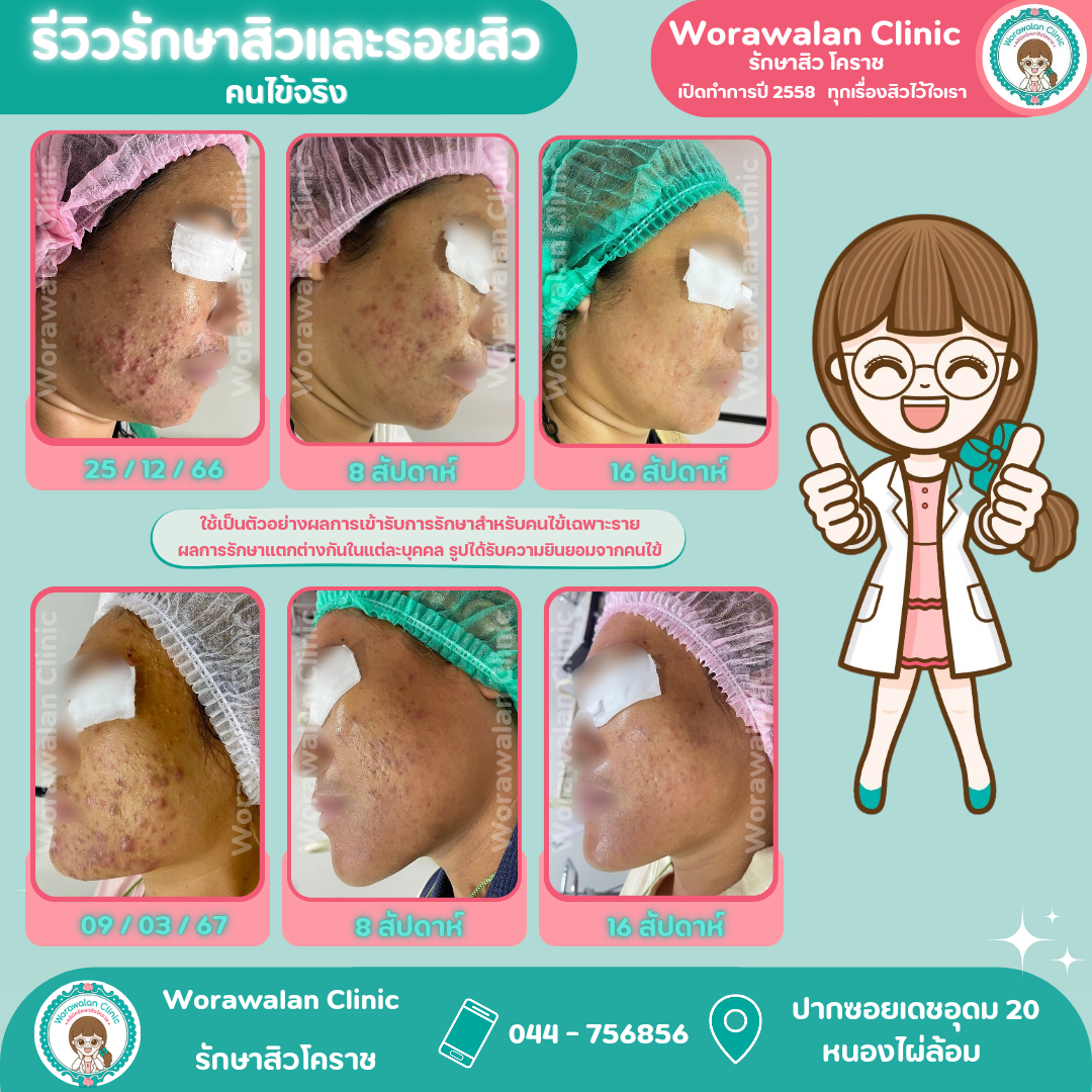 ภาพเปรียบเทียบก่อนหลังรักษาสิวและรอยดำสิว หมอเจี๊ยบ วรวลัญช์ คลินิก ประสบการณ์ 11 ปี