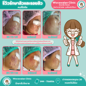 ผลลัพธ์รักษาสิวอักเสบเรื้อรังและสิวอุดตัน วรวลัญช์ คลินิก โคราช ไม่เลี้ยงไข้ เห็นผลจริง
