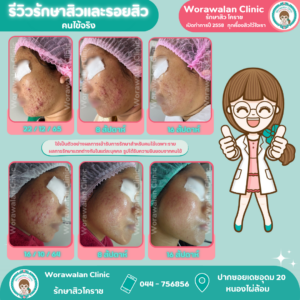 รีวิวรักษาสิวอุดตันและรอยแดง เห็นผลใน 16 สัปดาห์ วรวลัญช์ คลินิก โคราช โดยหมอเจี๊ยบ